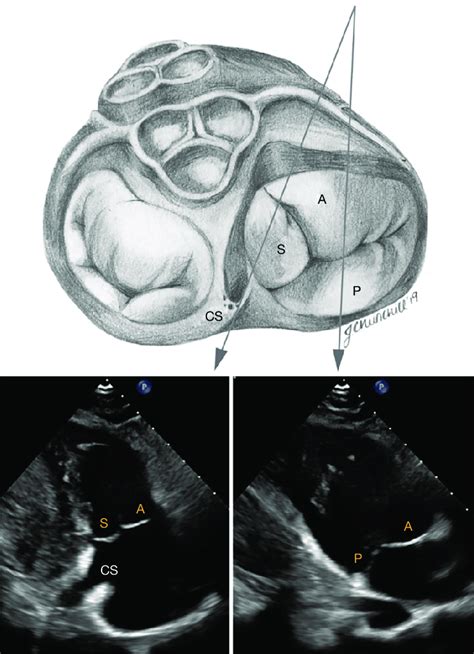 Transthoracic Imaging Of The Tricuspid Valve In The Modified