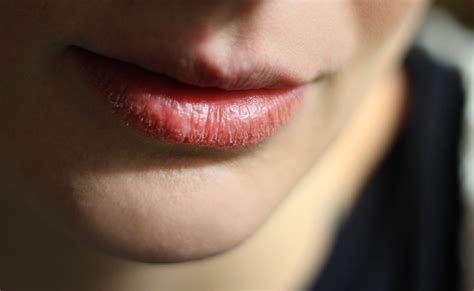 How Do You Treat A Rash On Your Lips