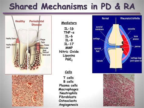 Ppt Rheumatoid Arthritis And Periodontal Disease Powerpoint