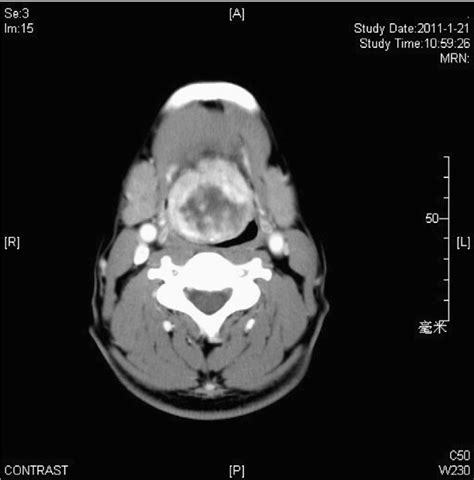 Figure 1 From Ectopic Lingual Thyroid With A Multinodular Goiter