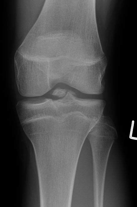 Tibial Eminence Fracture Image