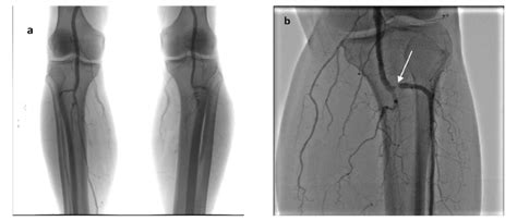 Figure 1 From Endovascular Treatment Of Acute Tibioperoneal Trunk
