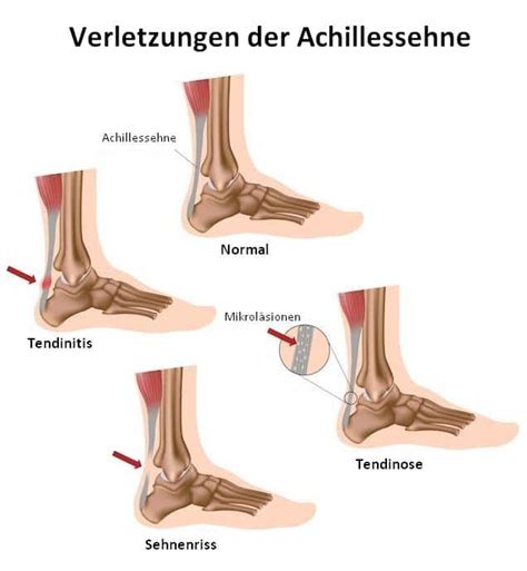 Eine daraus resultierende therapie/ behandlung zur wiederherstellung der funktion und beschwerdefreiheit der. Achillessehnenentzündung, Therapie, Schmerzen, chronische ...