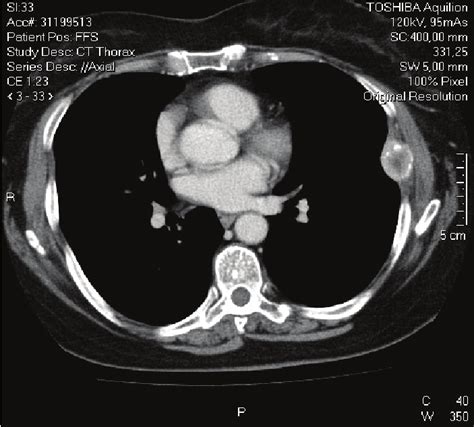 Ct Scan Showing Metastasis In The 7 Th Rib Left Download Scientific