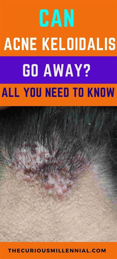 Can Acne Keloidalis Go Away What You Need To Know In 2021 Acne