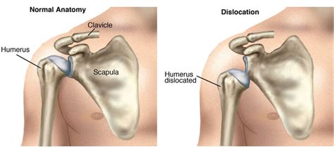 Shoulder Dislocations Types Diagnosis