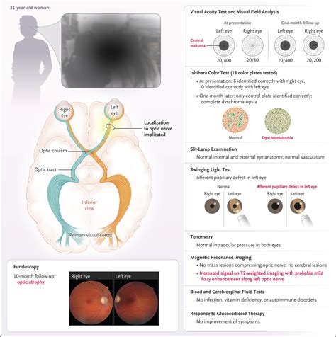 Case 21 2019 A 31 Year Old Woman With Vision Loss Nejm