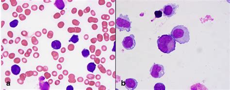 A Blood Wright Giemsa Stain 1000x Frequent Abnormal Promyelocytes