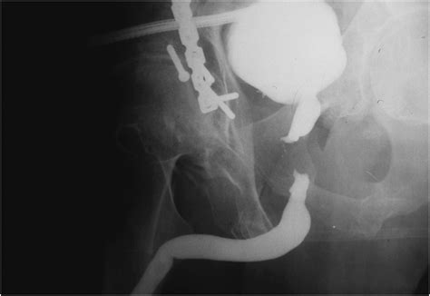 Urethral Stricture Disease Evaluation Of The Male Urethra Journal Of Endourology