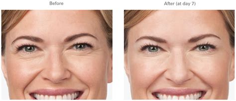 Botox Crows Feet Before And After Galleries Pictures Chugay