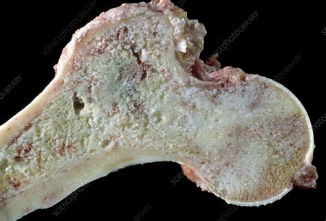 Bone Cancer Stock Image M1310422 Science Photo Library