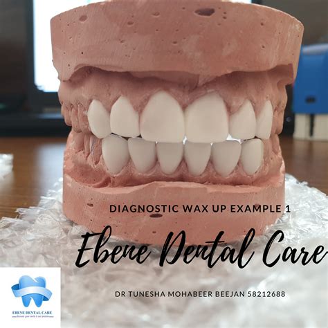 Dental Diagnostic Wax Up Tooth And Tips