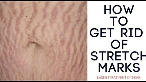 How To Treat And Prevent Stretch Marks Youtube