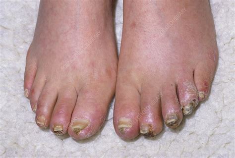 Oedema And Gangrene Affecting A Persons Toes Stock Image M1650034