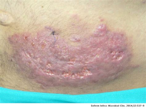 Dicho tipo de hongos se caracterizan por su rápido crecimiento y prolífica capacidad para formar esporas, cuyas conidias se pueden inhalar llevando a enfermedad en personas con un. Mucormicosis cutánea como complicación poco frecuente de ...