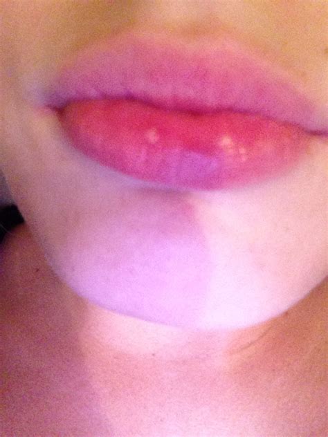 I Have A White Bump On My Lip Im Absolutely Sure Its Not A Cold Sore