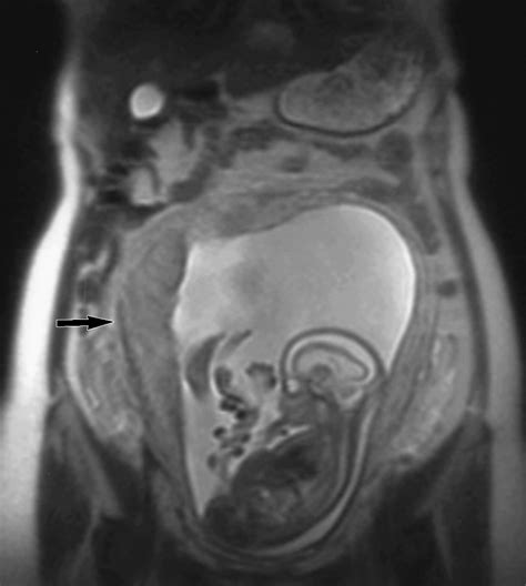 Normal Anatomy Of The Fetus At Mr Imaging Radiographics