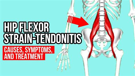 Hip Flexor Strain Tendonitis Causes Symptoms And Treatment Youtube