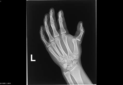 Dislocation Of Thumb Xray Radrounds Radiology Network