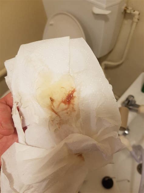 What Does Implantation Bleeding Look Like On Toilet P