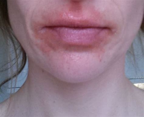 Rash On My Face And Lips