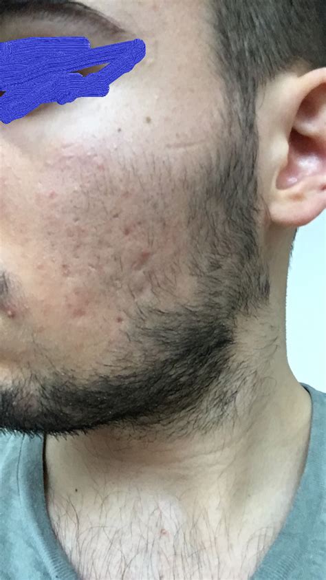 Need Advice Experience Help Me Please Acne Scars Scar