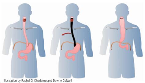 Esophageal Resection With Gastric Pull Up The Stomach Replaces The