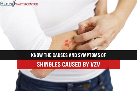 Shingles Causes Symptoms And Complications 3ff