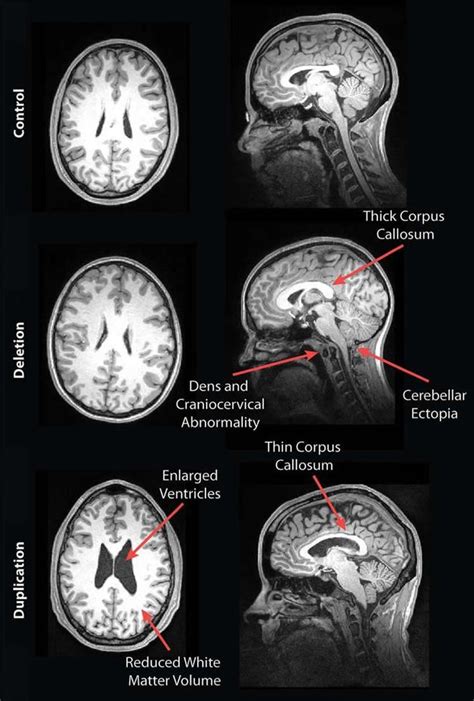 MRI Reveals Striking Brain Differences In People With Genetics Autism Brain Scan Mri Brain