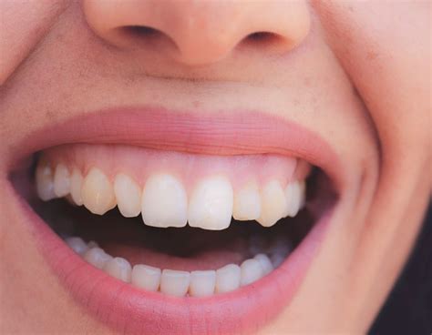 How To Get Rid Of Black Gums And Lips