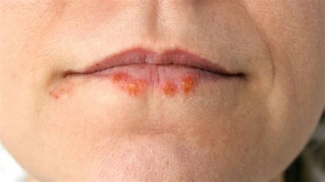 What Causes Canker Sores Wisteria