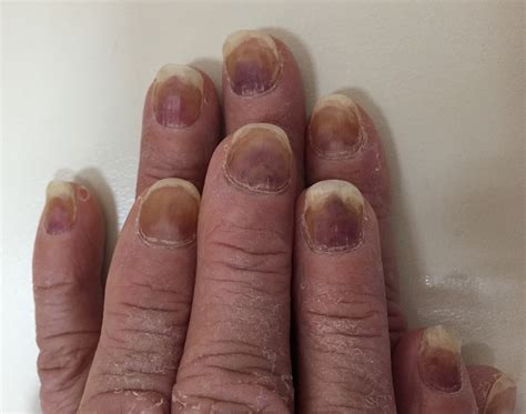 Nails With Bloodstained Discoloration The Bmj