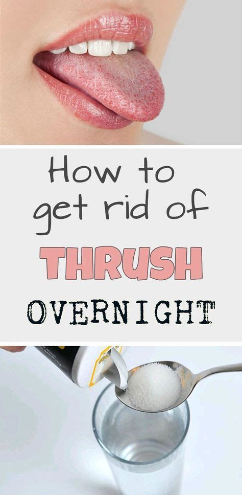 How To Get Rid Of Thrush Overnight Home Remedies For Thrush Oral Thrush Remedies Overnight