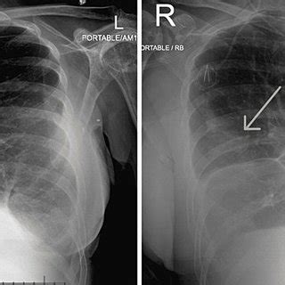 Antero Posterior Chest X Ray Showing Mild Bilateral Pleural Effusions