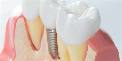 Dental Implants The Optimal Tooth Replacement Caribbean