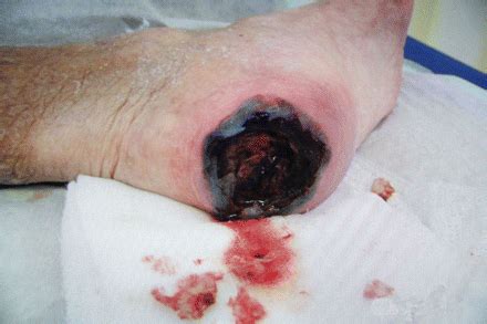 Decubitus Ulcers Stages Of Heel Decubitus Ulcer Hot Sex Picture