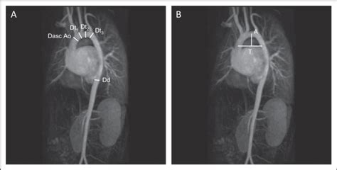 Aortic Arch Morphology By Magnetic Resonance Mr Angiography In A