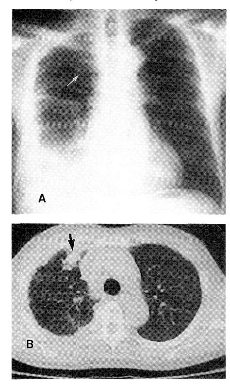 Figure 1 From Diagnosis Of Carcinomatous Pleurisy Using Thoracoscopy ―a