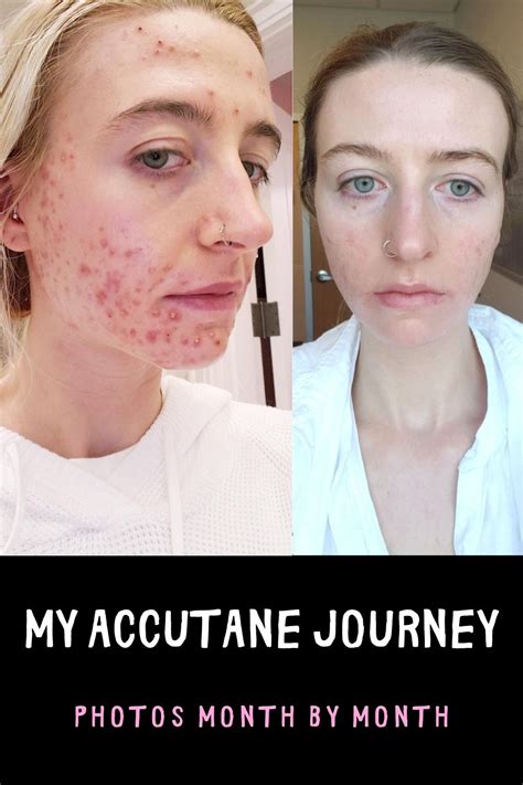 My Accutane Journey I Before After Photos Of Acne Clear Skin Dry Skin Treatment Accutane