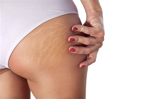 Stretch Marks The Science Behind The Cause And How To Treat Them
