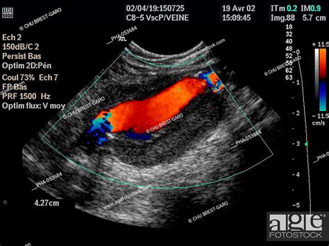 Color Doppler Ultrasound Scan Of An Aneurysm Of The Abdominal Aorta