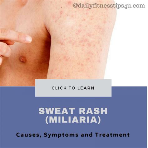 Sweat Rash Miliaria Causes Symptoms Risk Factors And Treatment
