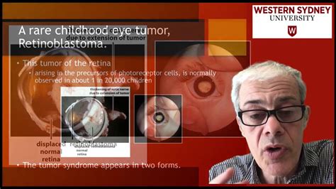 33 Retinoblastoma A Rare Childhood Eye Tumor Youtube