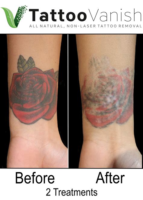 Best Tattoo Removal In Miami All Natural And Non Laser Tattoo Removal