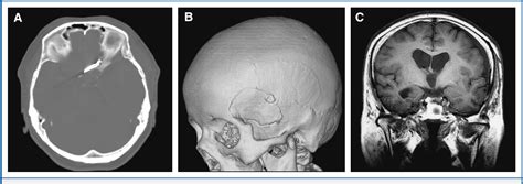 Figure 1 From Osteoplastic Pterional Craniotomy Revisited Semantic