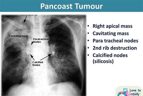 Pancoast Tumor Cxr Medizzy