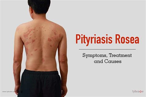 5 Things To Know About Pityriasis Rosea Pityriasis Ro