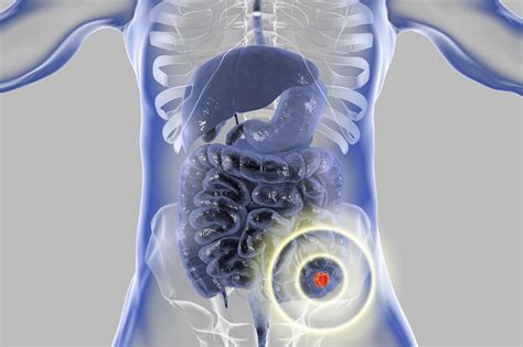 Mortality By Stage For Right Vs Left Sided Colon Cancer Health