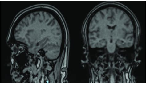 Her Mri Head Showed Signal Abnormality In The Left Posterior Parietal