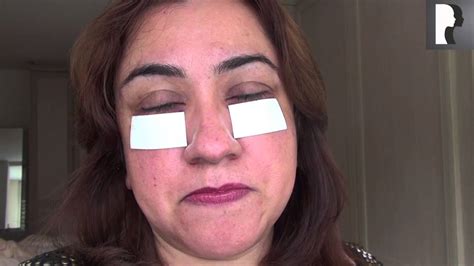 Blepharoplasty Video Diary Day After Surgery Recovery Progress